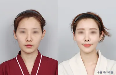 Before & After