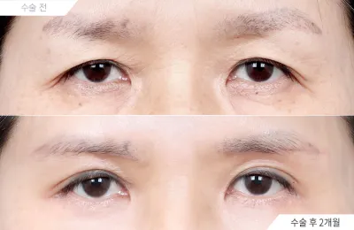 Before & After