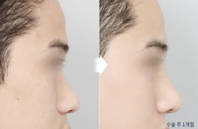 Before & After