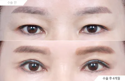 Before & After