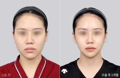 Before & After