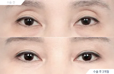 Before & After