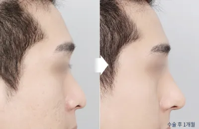Before & After
