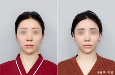 Before & After