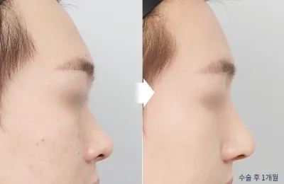 Before & After