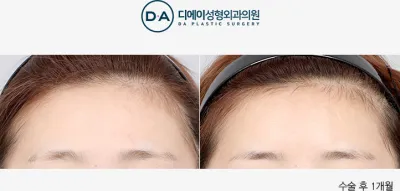 Before & After