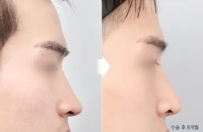 Before & After