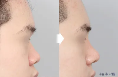 Before & After