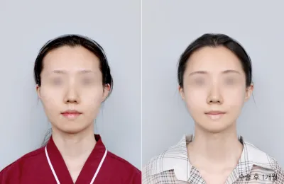 Before & After