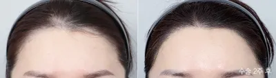 Before & After