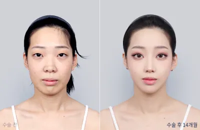 Before & After