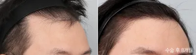 Before & After