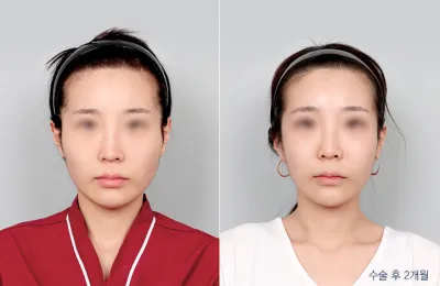 Before & After