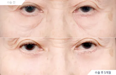 Before & After