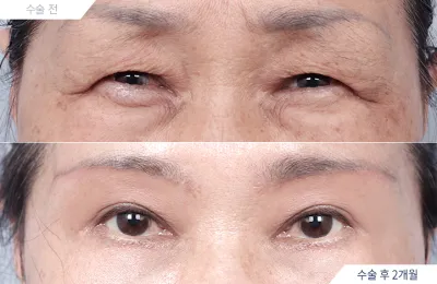 Before & After