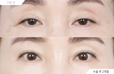 Before & After