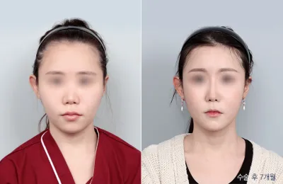Before & After