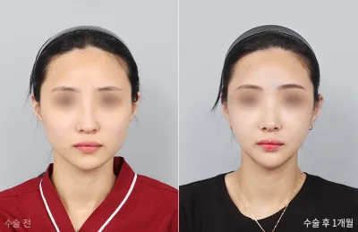 Before & After