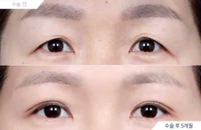 Before & After
