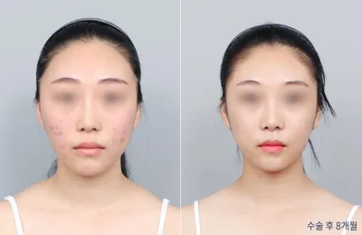 Before & After