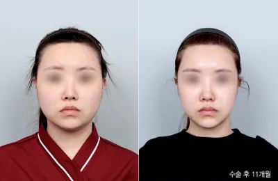 Before & After