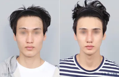 Before & After