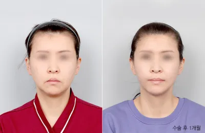 Before & After