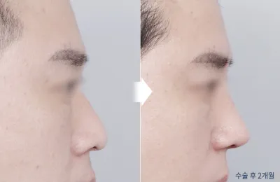 Before & After