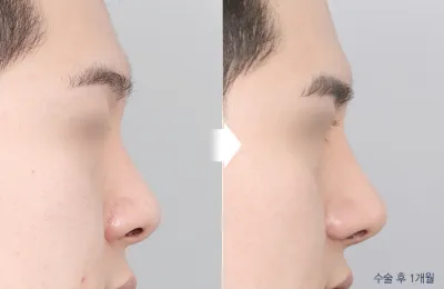 Before & After