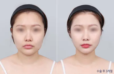 Before & After