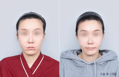 Before & After