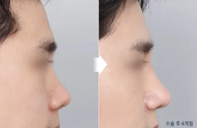 Before & After