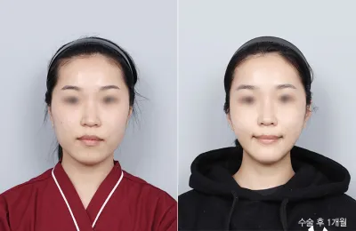 Before & After