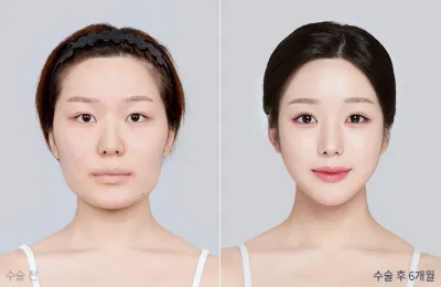 Before & After