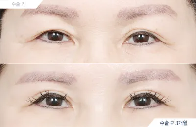Before & After