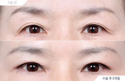 Before & After