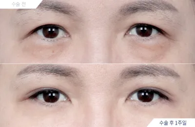 Before & After