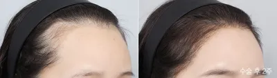 Before & After
