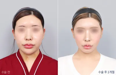 Before & After