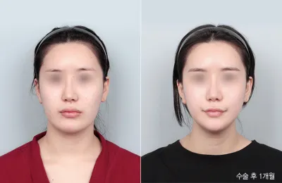 Before & After
