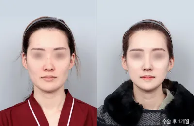 Before & After