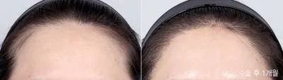 Before & After