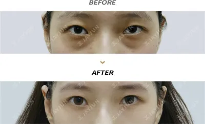 Before & After