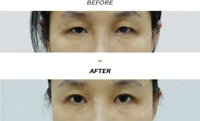 Before & After