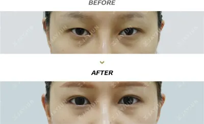 Before & After