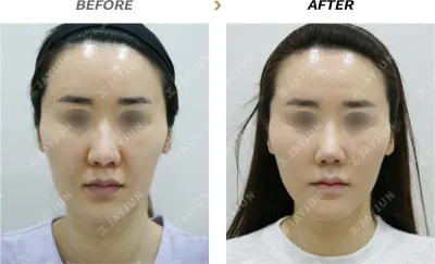 Before & After