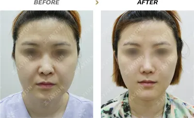 Before & After