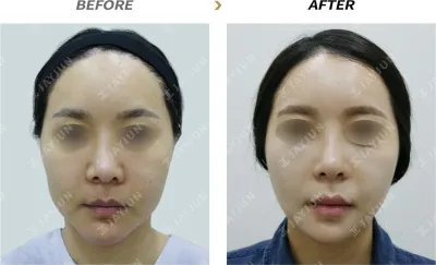 Before & After