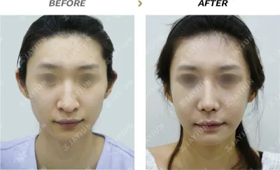 Before & After