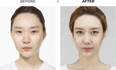 Before & After